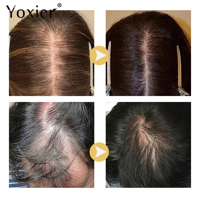 Yoğun büyüme serumu önlemek sa - Hair Care For Hair Loss incelemesi ve fiyatı